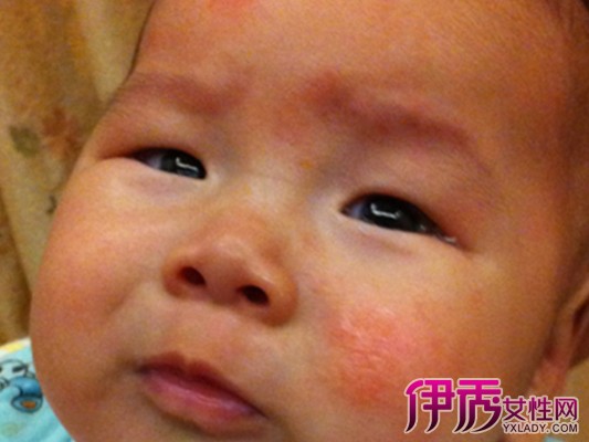 【四个月宝宝脸上长小红疙瘩】【图】四个月宝