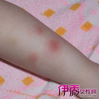 婴儿身上起红斑图片展示 揭秘婴儿红疹的3大病症