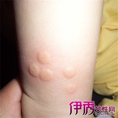 【图】宝宝丘疹性荨麻疹症状有哪些 揭秘皮肤上出现风团的原因