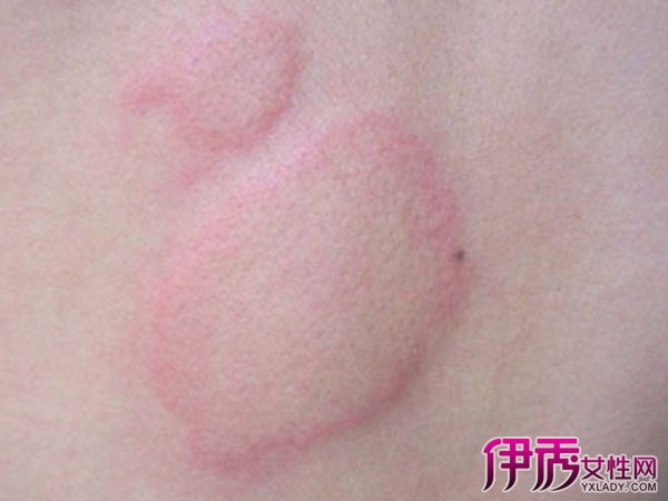 【小儿慢性荨麻疹偏方】【图】小儿慢性荨麻疹