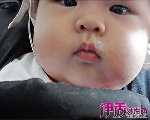【5个月宝宝感冒咳嗽流鼻涕怎么办】【图】5