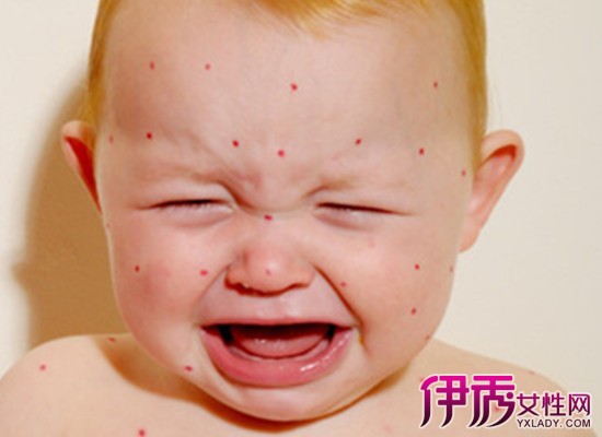 【小儿麻疹的治疗】【图】小儿麻疹的治疗方法
