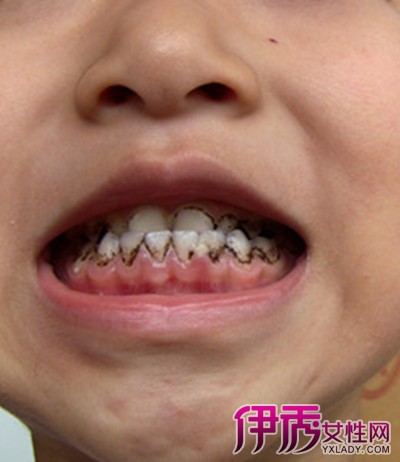 【小孩牙齿发黑的原因】【图】小孩牙齿发黑的