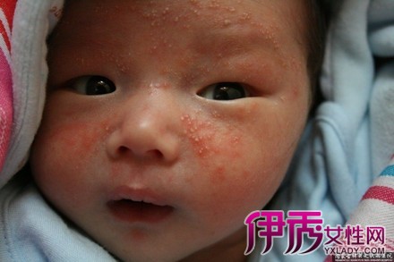 【图】婴儿湿疹怎么办 治疗婴儿湿疹方法_健康