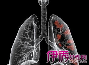 【图】肺癌的早期症状 发现肺癌早期的六大信