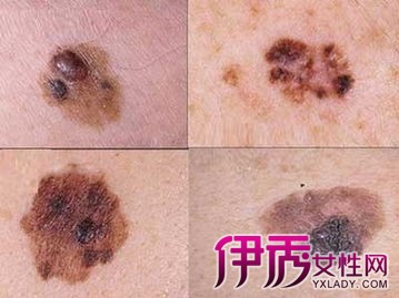【图】皮肤癌早期症状图片 皮肤癌的病因 皮肤癌的预防