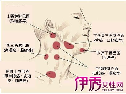 【图】颈部淋巴结肿大的原因 如何预防保健