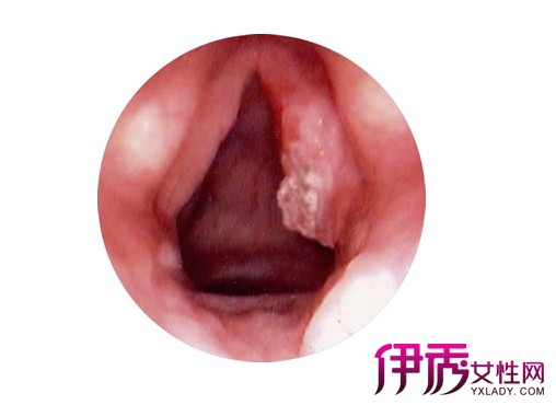【咽喉炎】【图】咽喉癌的早期症状 咽喉癌能