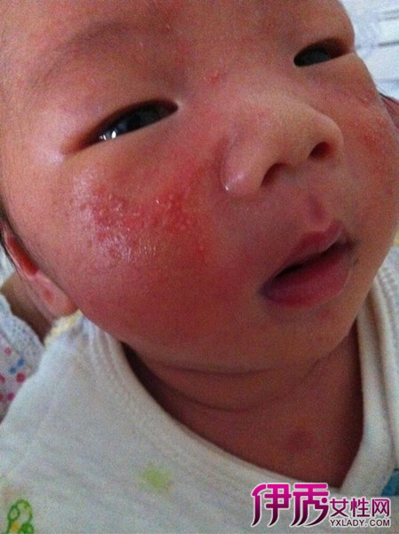 【图】面部湿疹 了解宝宝面部湿疹