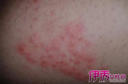 什么病】皮肤出现一片红水泡 疑为带状疱疹?(