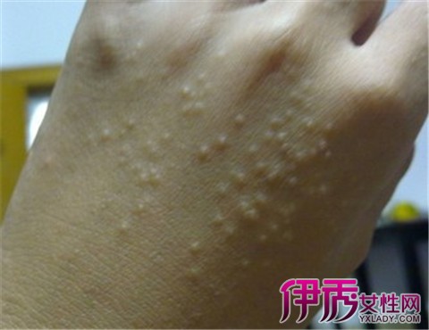 【图】水疱型手部湿疹怎么应对 五大建议让你手部恢复光滑