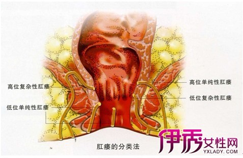 解答中药能治直肠瘘吗 中医疗法效果不明显并不能根治