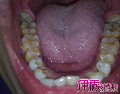 【洗牙后牙根痛】【图】洗牙后牙根痛是什么引