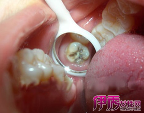 【图】洗牙后牙根痛是什么引起的 洗牙后应该
