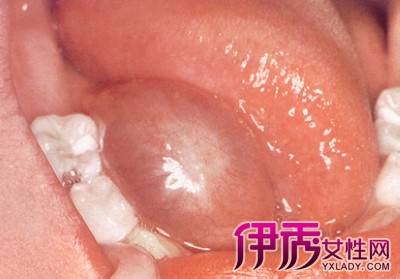 【舌下腺囊肿】【图】什么是舌下腺囊肿 舌下