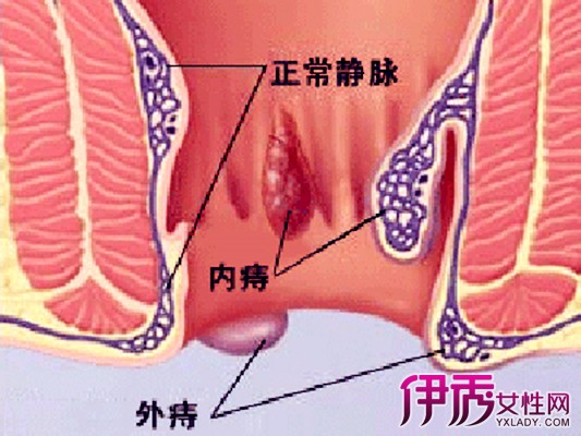 【图】肛门上长肉粒用什么药治疗医生提醒警惕