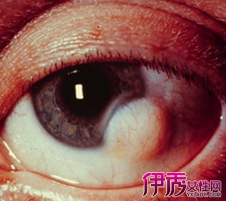 眼部囊肿图片曝光 为你详解眼部囊肿瘤的4大临床表现