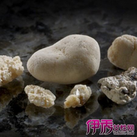 【肾结石排出的石头】【图】展示肾结石排出的