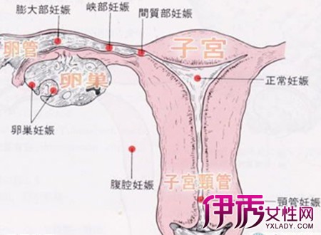 【图】宫外孕图片示意图汇总 专家告诉你宫外孕是怎样的