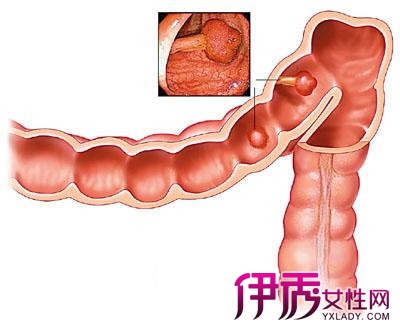 【直肠癌晚期能活多久】【图】直肠癌晚期能活