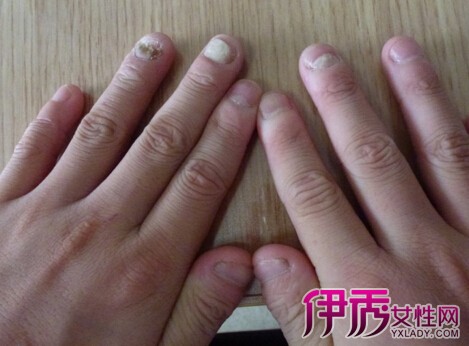 【灰指甲治疗方法】【图】揭秘灰指甲治疗方法