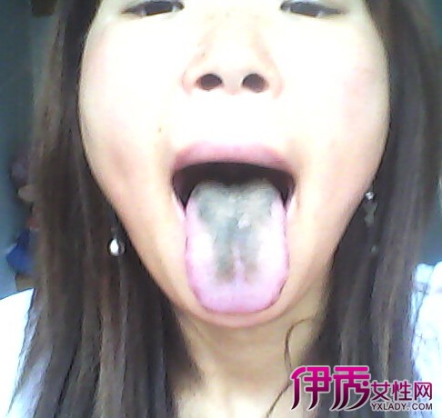 【舌头发黑图片】【图】盘点舌头发黑图片 5大