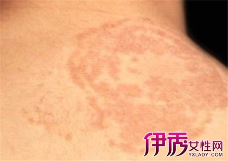 【花斑癣是怎么治疗】【图】花斑癣是怎么治疗