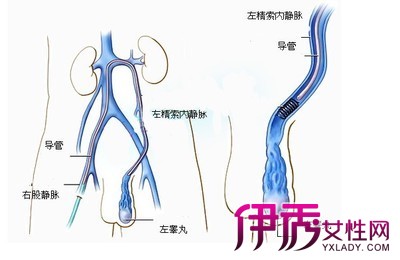 精索静脉曲张症状 如何治理精索静脉曲张