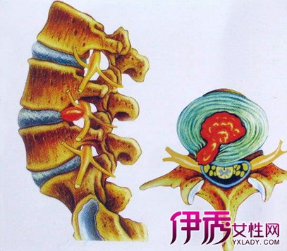 【图】腰椎压迫神经腿疼中医保守治疗可缓解