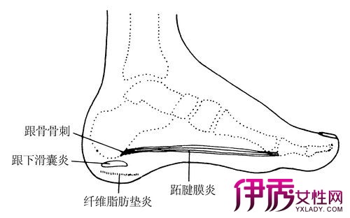 【图】脚跟痛是什么原因 6个病因为你解读