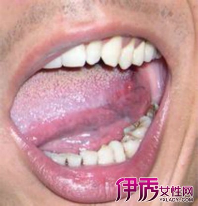 【图】舌头溃疡图片大全 如何治疗口腔溃疡