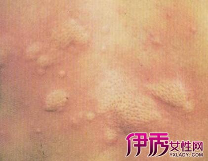 【表皮囊肿】【图】表皮囊肿怎么办? 四大妙招