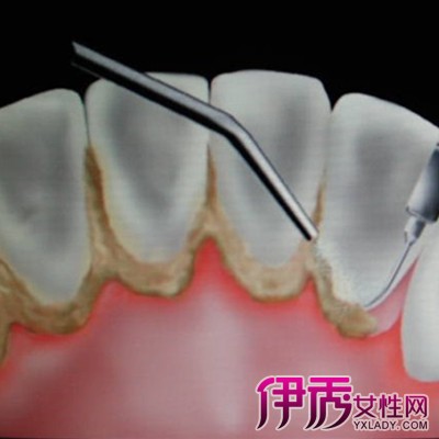 【牙周炎图片】【图】牙周炎图片展示 四大病