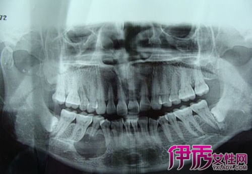 【牙龈囊肿图片】【图】严重的牙龈囊肿图片 