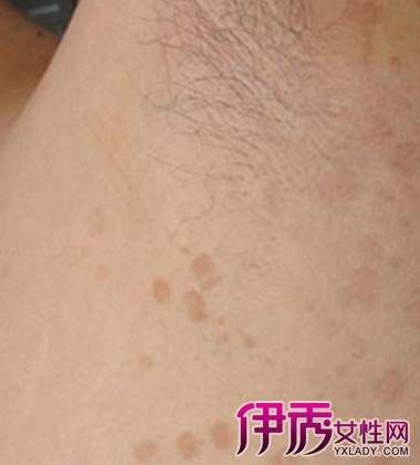 【花斑癣怎么治疗】【图】花斑癣怎么治疗? 介