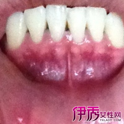 需要强调的是,如果牙龈或上腭部黑色素沉着区变得粗糙,隆起,容易出血