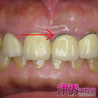 【图】牙龈变黑是怎么回事 暗示三大健康因素