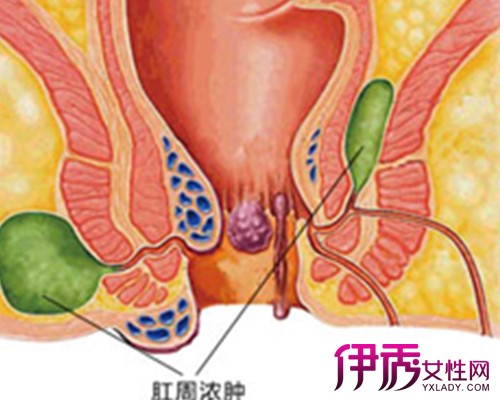 【图】肛周囊肿早期图片展现 此病状的临床表现和初步诊断分析