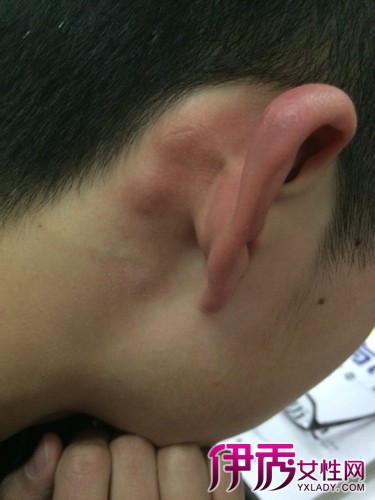 【图】耳背后面有个包肿痛怎么办 关键是要对症下药