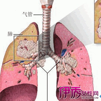 【肺癌治疗】【图】肺癌治疗的方法 第一时间