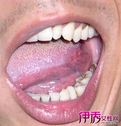 舌头癌早期症状图片_舌头癌能活多久