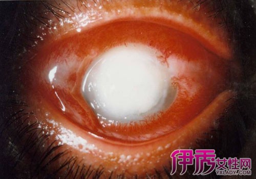 【图】严重的角膜炎症状图片 怎么较好地治疗角膜炎?