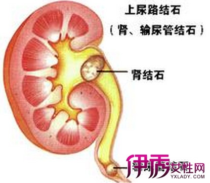 3.后尿道结石可用尿道探条将结石轻轻地推入膀胱,再按膀胱结石处理.