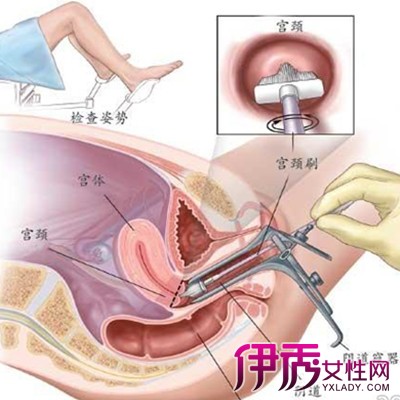 【宫颈液基细胞检查】【图】关于宫颈液基细胞