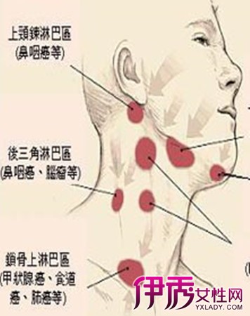 【淋巴结发炎】【图】怎么治疗淋巴结发炎? 多