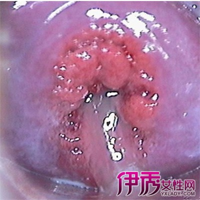 【宫颈糜烂怎么引起的】【图】宫颈糜烂怎么引