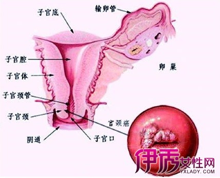 dwi在宫颈癌盆腔淋巴结转移诊断中的应用