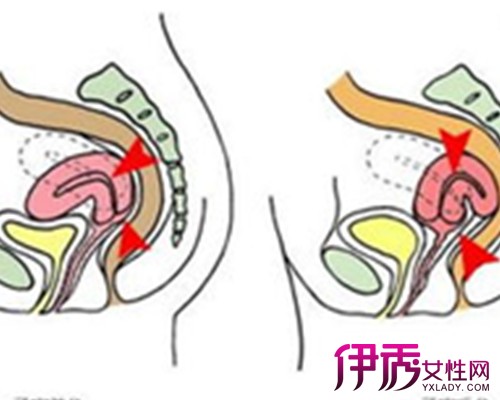 【图】纠正子官后位睡姿图片 子宫后位的治疗和保健