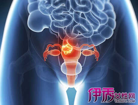 症的特征有哪些? 多囊卵巢综合症需注意什么?