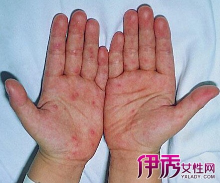 【手足口病症状初期图片】【图】手足口病症状